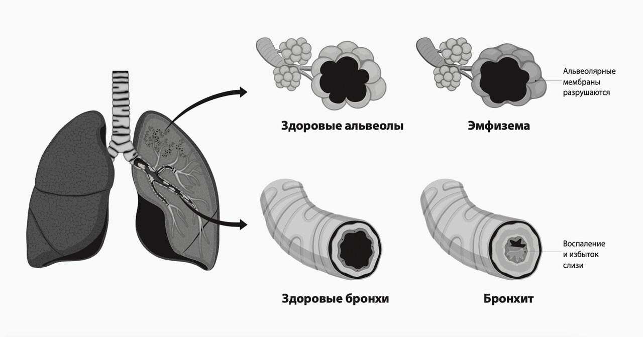 Если долго курить, легкие будут как пакет, который не может сдуться сам.  При астме легкие — сложенный пакет, совсем без воздуха. Но лечить это нужно  одинаково Отрывок из книги «Медицина для умных» —