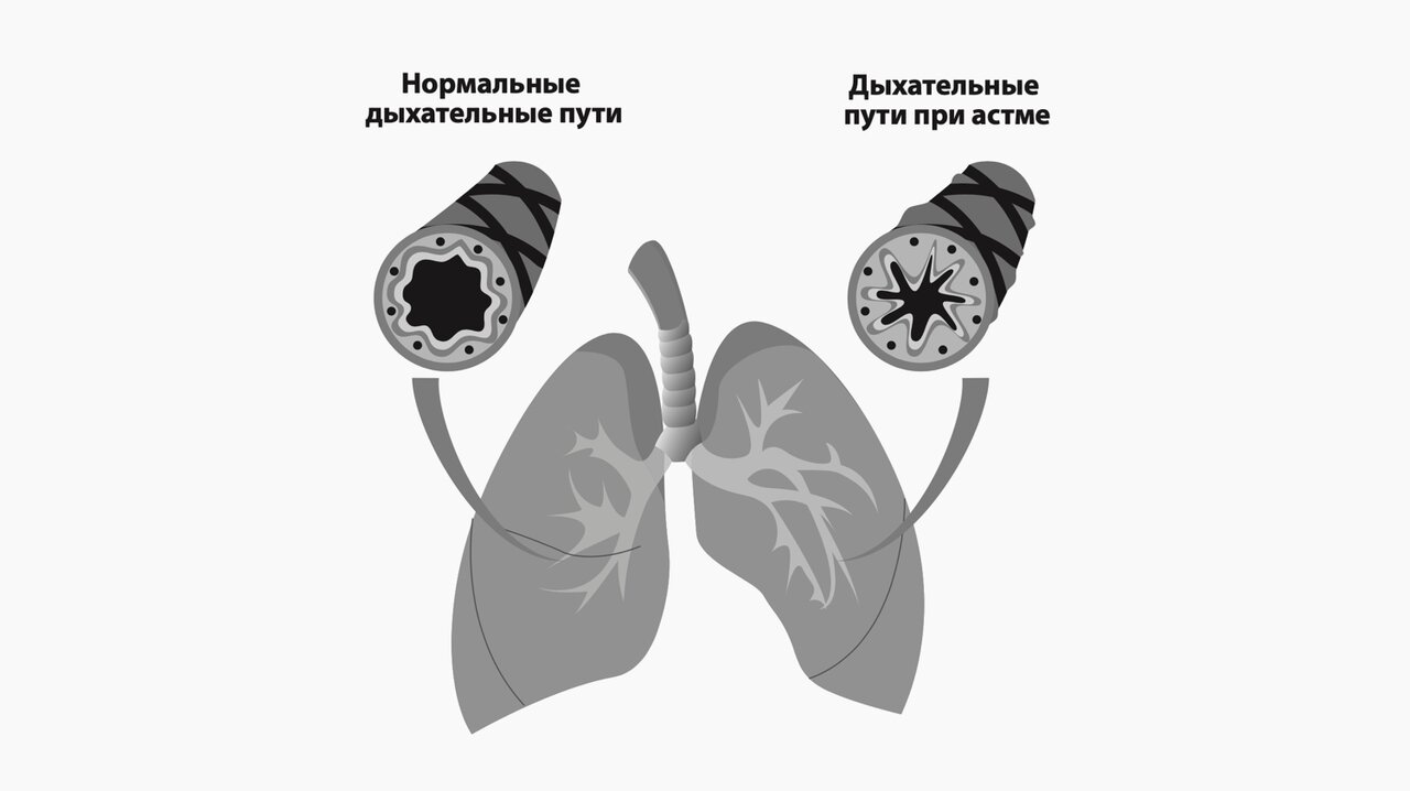 Астма легких. Лёгкие астматика и нормального человека.