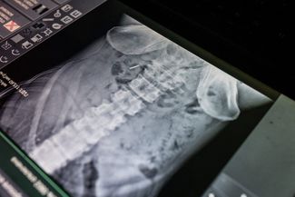 Рентгеновский снимок с осколками на стабилизационном медпункте на бахмутском направлении, 14 июля