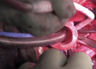 Операция по пересадке трахеи по методу доктора Маккианери, июль 2011 года