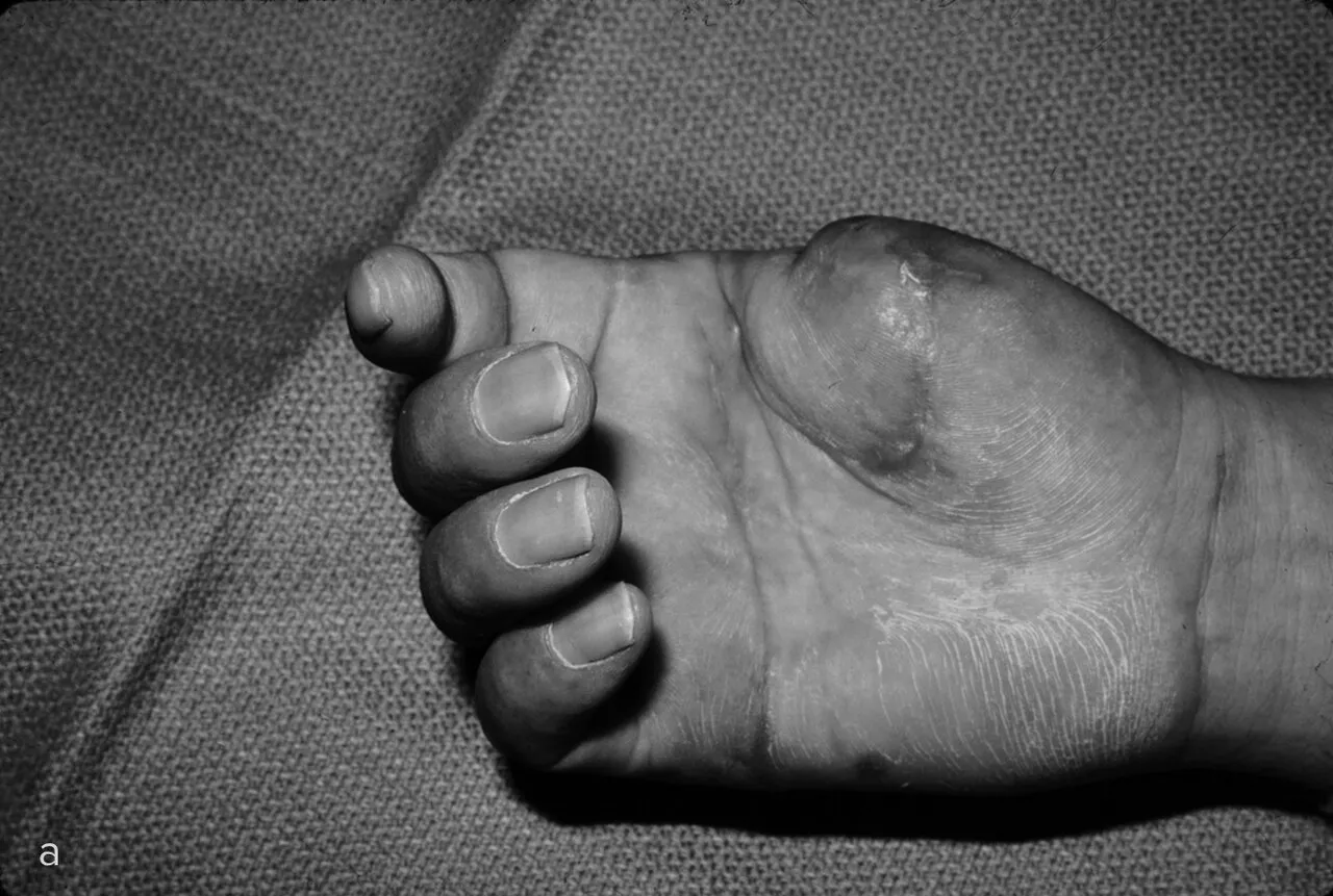 Почему травмировать или потерять большой палец руки хуже, чем любой другой?И как врачи помогают таким пациентам? Фрагмент книги ортопеда Роя Милза«Кости: внутри и снаружи» — Meduza