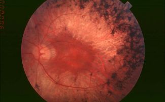Глазное дно пациента с пигментным ретинитом в средней стадии
