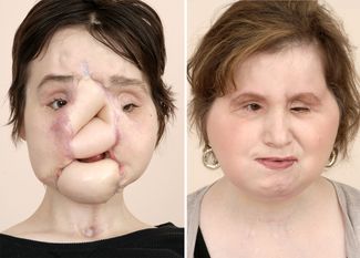 Кэти до и после операции по пересадке лица