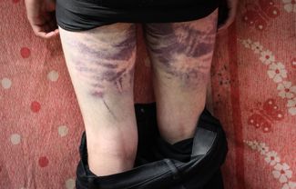 Bruises on the legs of a person arrested during the 2020 protests in Minsk. August 14, 2022