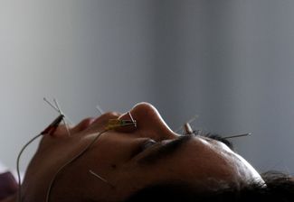 Пациент проходит курс лечения иглоукалыванием в больнице традиционной медицины в Хэфэе (это городской округ на востоке Китая)