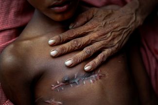 Семилетний Мохаммед Шоаиб был ранен в грудь при попытке пересечь границу Мьянмы. 5 ноября 2017 года