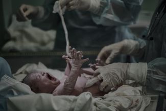 Ребенок, родившийся с помощью кесарева сечения, сделанного из-за врастания плаценты
