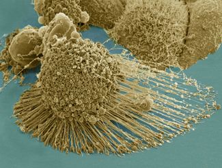 Клетки HeLa во время клеточной смерти — апоптоза. Изображение получено сканирующим электронным микроскопом, цвета условны.