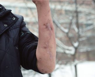 Scars on Rashid Igisinov’s arm after his injury on January 5, 2022