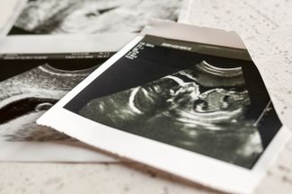 Снимки УЗИ на четвертой и 20-й неделе беременности